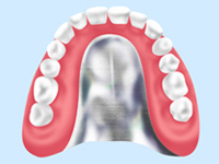 金属床義歯（総義歯の場合、保険の先進医療の補助が受けられます）