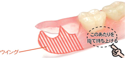 ノンクラスプデンチャー（入れ歯）を上手に外すには